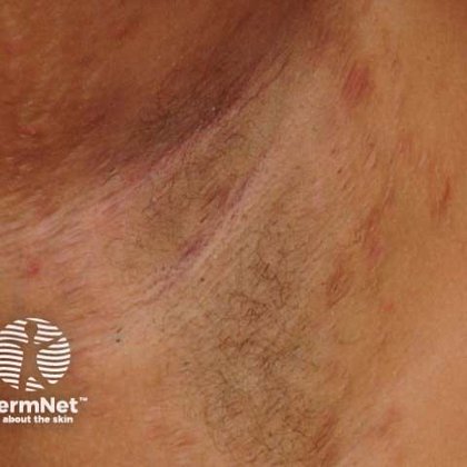 Long-term BE HEARD Data Show Durable HiSCR Responses With Bimekizumab in HS | Dermatology Times