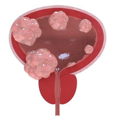 Nadofaragene Firadenovec Label Update Approved in BCG-Unresponsive NMIBC | CancerNetwork