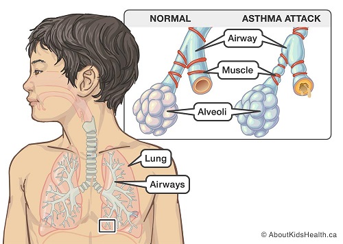 Muscles tightened around airways in a child's lungs during an asthma attack 