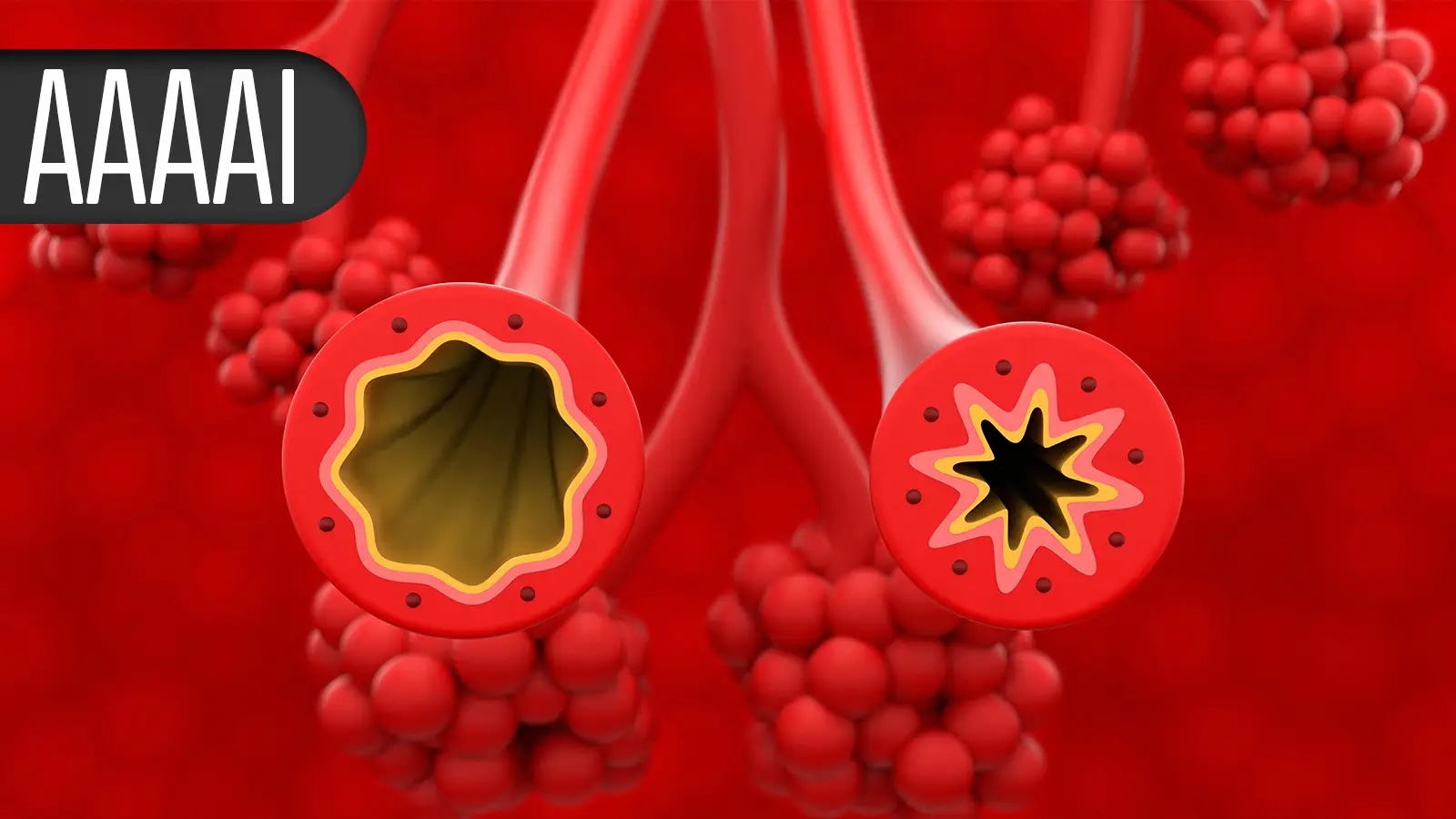 Biologic on Par With Oral Immunotherapy for Turning Allergy-Forbidden Foods Into Everyday Eats