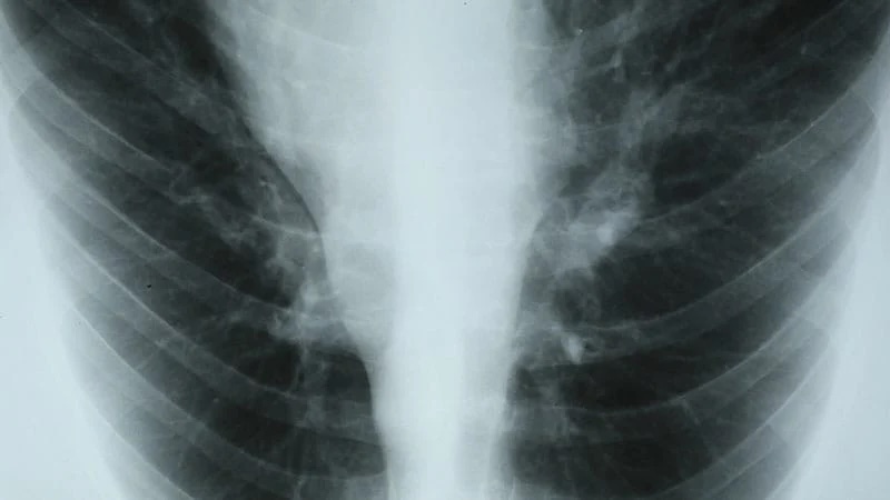 Adults with severe #asthma were more likely to discontinue #biologic #therapy based on nonclinical reasons than based on #side #effects or #ineffectiveness
