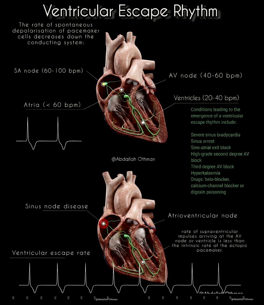 Ventricular Escape Rhythm
Protective idioventricular rhythm (20–40 bpm) emerges when SA/AV node failure allows ventricular pacemaker takeover. ECG: wide QRS (>120 ms), regular slow rate, AV dissociation, no related P waves.
Key Causes
Severe sinus bradycardia/arrest, high-grade/complete AV block, hyperkalemia, drug toxicity (beta-blockers, CCBs, digoxin), MI/ischemia, sick sinus syndrome.
Management
Identify & treat cause (electrolytes, ischemia, toxins). Emergent pacing (transcutaneous → transvenous) if unstable (hypotension, shock); permanent if irreversible. Never suppress—it's lifesaving!
#Cardiology #ECG #Arrhythmia #MedEd #HeartBlock #Pacing #ACLS