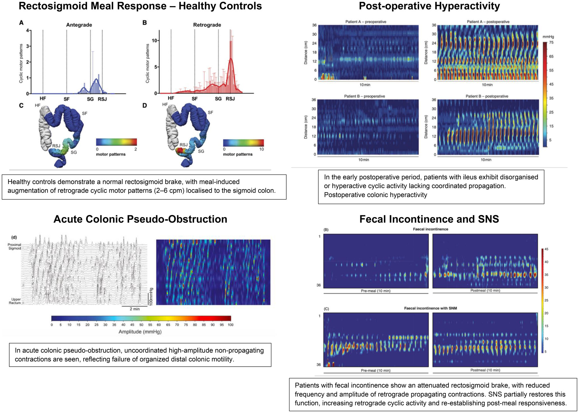 Key Points

The distal colon has a natural “brake” (the rectosigmoid brake) that controls how quickly stool enters the rectum, helping prevent urgency and maintain continence.
When this brake misfires, different problems can result: after colorectal surgery it may become overactive and delay recovery; when weakened or removed it can lead to urgency or incontinence.
This brake is a promising, measurable sign to guide care: it can be boosted by sacral nerve stimulation, and new non-invasive tests may help doctors track it to predict recovery and tailor treatment.