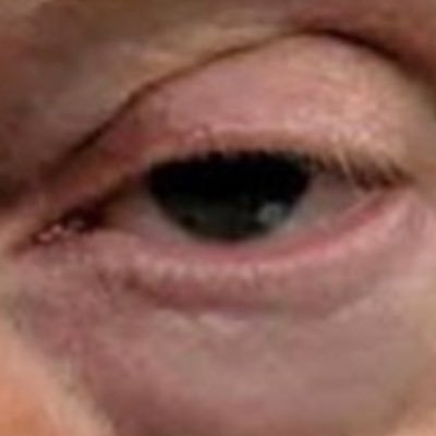Donald Drumpf’s Left Eye
