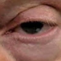 Donald Drumpf’s Left Eye